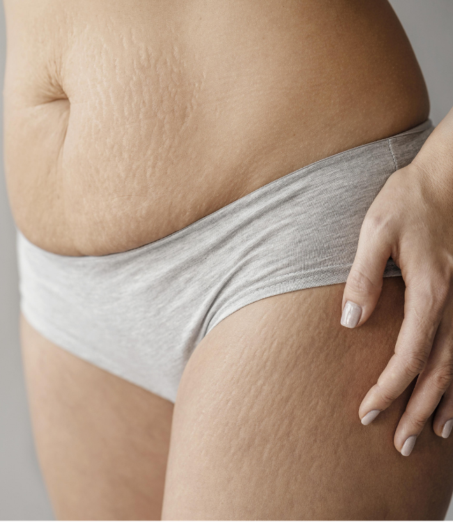 Cellulite4