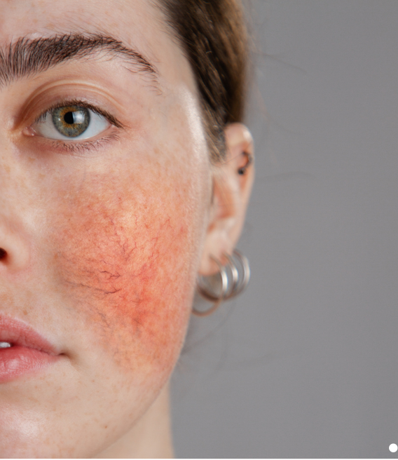 Rosacea slider 01