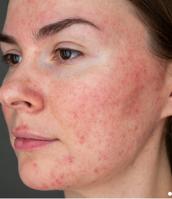 Rosacea slider 02