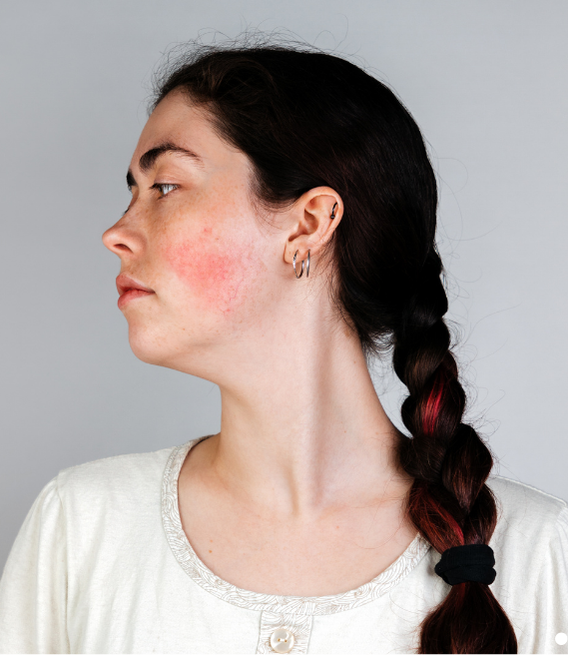 Rosacea slider 03